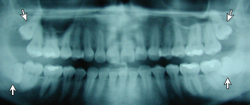 Panoramic x-ray of impacted teeth
