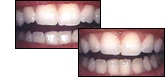 before and after enamel shaping