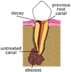 abscess